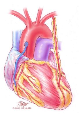  Vascular Grafts！Revolutionizing Cardiovascular Surgery and Enhancing Patient Outcomes!